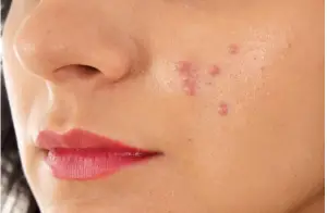 الحبوب في الوجه في المنام للعزباء